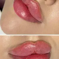 تزریق ژل فیلربوتاکس تخفیفات50درصدی برای زیباجویان|خدمات آرایشگری و زیبایی|زاهدان, |دیوار