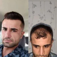 کاشت مو ابرو ریش تارکوب