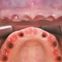 دندانپزشکی تخصصی ایمپلنت دیجیتالی و فوری|خدمات آرایشگری و زیبایی|تبریز, |دیوار