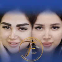 کاشت ابرو تخصصی در درمانگاه کمیل|خدمات آرایشگری و زیبایی|اهواز, زیتون کارمندی|دیوار