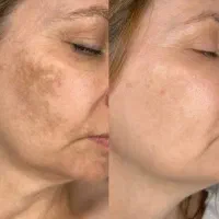 کرم سفیدکننده پوست وضدلک قوی گلدن کویین|آرایشی، بهداشتی، درمانی|مرودشت, مسجد رسول|دیوار