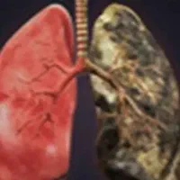 پاکسازی ریه افرادسیگاری،مصرف کننده قلیان توسط پزشک