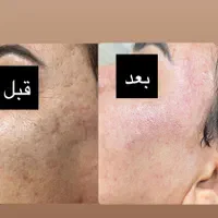 درمان قطعی گودی و فرو رفتگی ناشی از جای جوش|خدمات آرایشگری و زیبایی|شیراز, ارم|دیوار