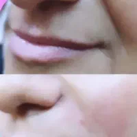 انجام ژل و بوتاکس با بهترین مواد اقساطی|خدمات آرایشگری و زیبایی|آزادشهر, |دیوار