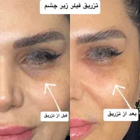 آموزش فیلر،بوتاکس،مزو،مزو ژل با مدرک|خدمات آموزشی|آبادان, |دیوار