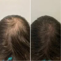 میکرواسکالپ سر کاری غیر تهاجمی|خدمات زیبایی و سلامت|همدان, |دیوار