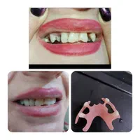 دندان متحرک مصنوعی بجای ایمپلنت فوری و سریع|آرایشی، بهداشتی، درمانی|رشت, گلسار|دیوار