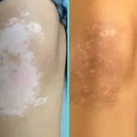 درمان پیسی و پسوریازیس|خدمات آرایشگری و زیبایی|کارون, |دیوار