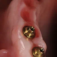 ایمپلنت با اقساط بلند مدت در تبریز|خدمات آرایشگری و زیبایی|اهر, |دیوار