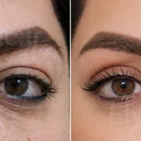 بلفارو پلاستی ۷ تومن کاشت ابرو و مو ساکشن|خدمات زیبایی و سلامت|کرج, اتحاد|دیوار