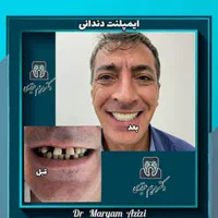پایتخت ایمپلنت دندان دندانپزشکی تضمینی تعرفه دولتی|خدمات آرایشگری و زیبایی|شیراز, معالی‌آباد|دیوار