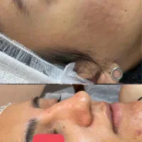 درمان قطعی لک و جوش در کوتاهترین زمان