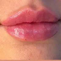 تزریق ژل و بوتاکس هایفو مزوو جوانساز