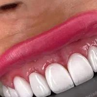 مدل برای ونیر کامپوزیت وعکاسی برای اینستاگرام مطب
