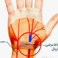 درمان کامل کانال مچ ولرزش وبیحسی دست