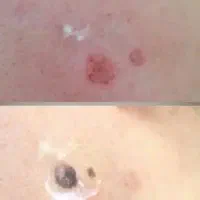 برداشتن خال ومنگوله های پوستی ولکه های سطحی بالیزر|خدمات آرایشگری و زیبایی|الیگودرز, |دیوار