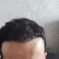 کاشت مو و کاشت ابرو (درحد رایگان)