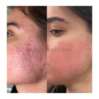 آموزش تکنیک پوست بچه