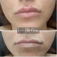 تزریق تخصصی فیلر|خدمات آرایشگری و زیبایی|شیراز, تندگویان|دیوار