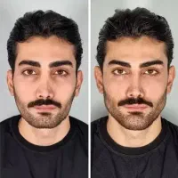 تزریق فیلر،بوتاکس،مزو تراپی.پی ار پی،پک جوانساز