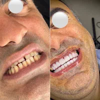 کلینیک تخصصی کامپوزیت دندان تمام اقساط در شیراز