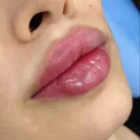 ژل و بوتاکس|خدمات آرایشگری و زیبایی|مسجد سلیمان, |دیوار