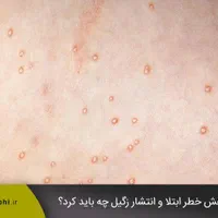زگیل تناسلی|خدمات آرایشگری و زیبایی|تبریز, |دیوار