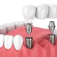 ٪80 تخفیف کامپوزیت کاشت دندان 11 تومن