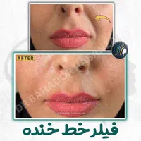 فیلر(ژل) لب گونه چانه خط خنده زاویه توسط پزشک رشت|خدمات آرایشگری و زیبایی|رشت, گلسار|دیوار