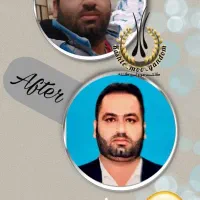 کاشت مو و ابرو و ریش|خدمات آرایشگری و زیبایی|شیراز, قدوسی غربی|دیوار