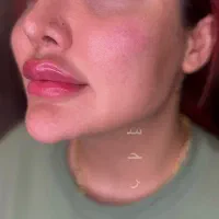 ژل و بوتاکس در تخفیف عیدانه