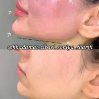 50 درصد تخفیف تزریقات ژل و بوتاکس|خدمات آرایشگری و زیبایی|اهواز, کوی رمضان|دیوار