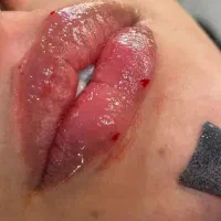 ژل فیلر آنزیم بوتاکس ناخن