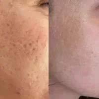 برداشتن خال وزگیل جوانسازی پاک کردن تاتو صورت وبدن|خدمات زیبایی و سلامت|کرمانشاه, |دیوار