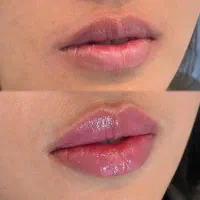 جشنواره ویژه ژل و بوتاکس مطب دکتر رویا جعفری|خدمات آرایشگری و زیبایی|اهواز, کوی علوی|دیوار