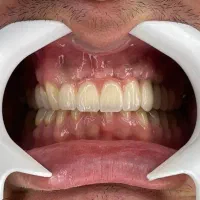 ایمپلنت یکروزه فقط با16تومان (بیمه واقساط)|خدمات زیبایی و سلامت|تهران, دردشت|دیوار