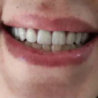 دندان سازی پروتز متحرک|خدمات آرایشگری و زیبایی|کرج, شاهین‌ویلا|دیوار