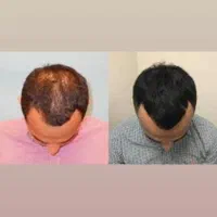 پی آر پی مو و صورت  فقط ۱۱۰۰