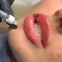 تزریق ژل وبوتاکس