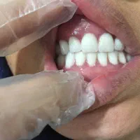 ساخت دندان مصنوعی|آرایشی، بهداشتی، درمانی|گلستان (تهران), |دیوار