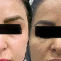 رفع لک با لیزر ترکیبی تک جلسه co۲