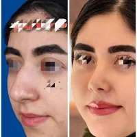 اورمیه/دکتر غنی‌زاده/جراحی سپتورینوپلاستی بینی