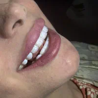 کامپوزیت/اقساط/لمینت/عصبکشی