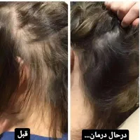 درمان ریزش مو|آرایشی، بهداشتی، درمانی|مشگین شهر, |دیوار