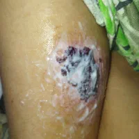 پماد سوختگی دست و پا|آرایشی، بهداشتی، درمانی|شیراز, لشکری‎|دیوار