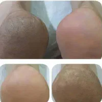 پدیکور وکفسابی