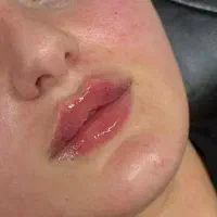 پی آر پی ۸۰۰، فیلر بوتاکس