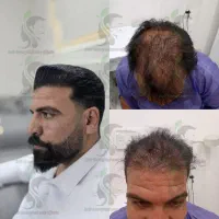 کاشت مو به روش میکرو گرافت