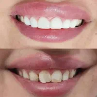 لمینت مترحک دندان اصل