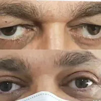 بلفاروپلاستی تخصصی در مطب پزشک زیبایی|خدمات آرایشگری و زیبایی|قم, شهرک قدس|دیوار